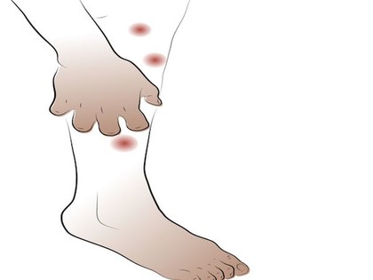 Type 2 Diabetes: Early Signs & Symptoms