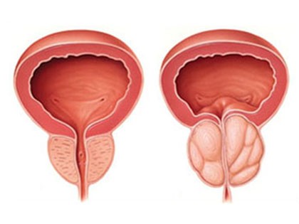 How To: Boost Prostate Health (Do This Daily)