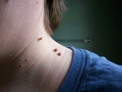 Got Skin Tags? Here's the Most Painless Way to Remove Them!