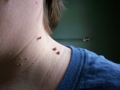 Got Skin Tags? Here's the Most Painless Way to Remove Them!